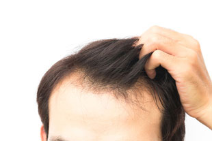 Stirn haarausfall frau vorne Haarausfall bei